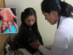 La ‘enfermedad de las ampollitas’ en manos, pies y boca se expande: 199 niños infectados en Huancayo