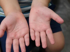 Tingo María: Alerta sanitaria en colegios por brote de casos por virus Coxsackie
