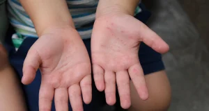 Tingo María: Alerta sanitaria en colegios por brote de casos por virus Coxsackie